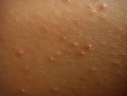 Keratosis pilaris images | DermNet NZ